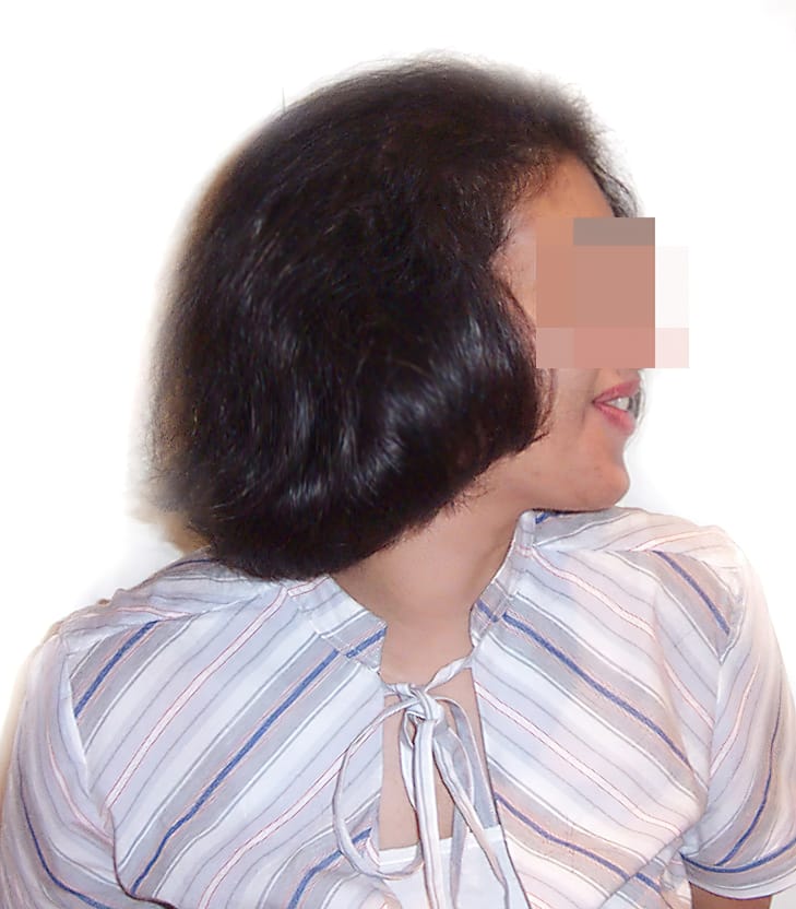 After Picture - Androgenetic Alopecia / Stress
